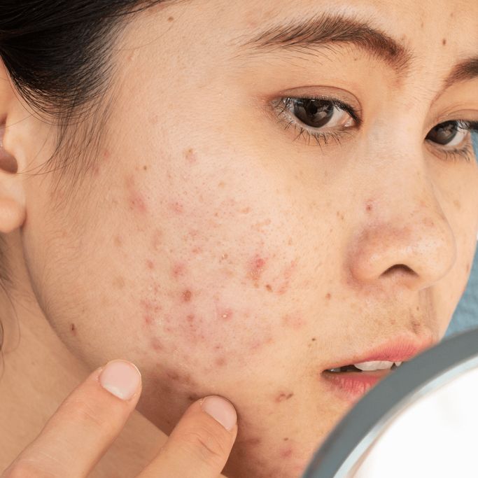 Stăpânirea artei îngrijirii pielii: un ghid cuprinzător pentru pielea predispusă la acnee